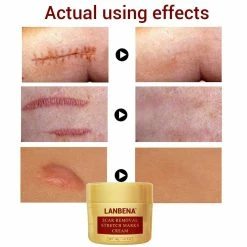 Lanbena Scar Removal Cream For New & Old Scars - Stretch Marks Relief And Burns Repair Acne Mark Removal Cream 13 Lanbena Scar Removal Cream For New & Old Scars - Stretch Marks Relief And Burns Repair Acne Mark Removal Cream -Moisturizers Sales 3gsrml1xvma4dxbju6dn7fjgjuaw