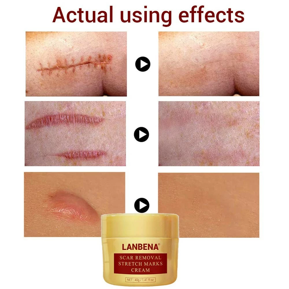 Lanbena Scar Removal Cream For New & Old Scars - Stretch Marks Relief And Burns Repair Acne Mark Removal Cream 7 Lanbena Scar Removal Cream For New & Old Scars - Stretch Marks Relief And Burns Repair Acne Mark Removal Cream - Image 5