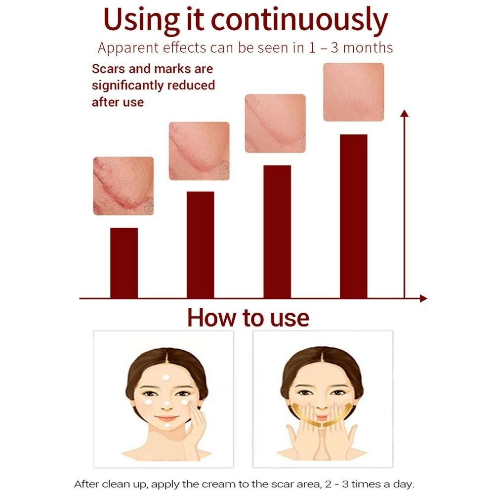 Lanbena Scar Removal Cream For New & Old Scars - Stretch Marks Relief And Burns Repair Acne Mark Removal Cream 8 Lanbena Scar Removal Cream For New & Old Scars - Stretch Marks Relief And Burns Repair Acne Mark Removal Cream - Image 6